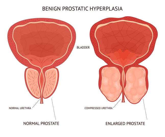 Benign Prostatic Hyperplasia (BPH): Symptoms & Treatment