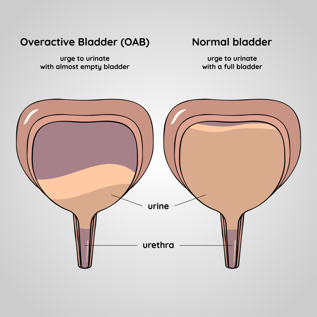 What does an overactive bladder look like compared to a normal bladder?