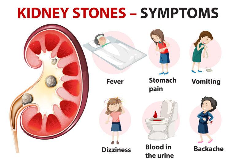 Illustration of Kidney Stones and symptoms