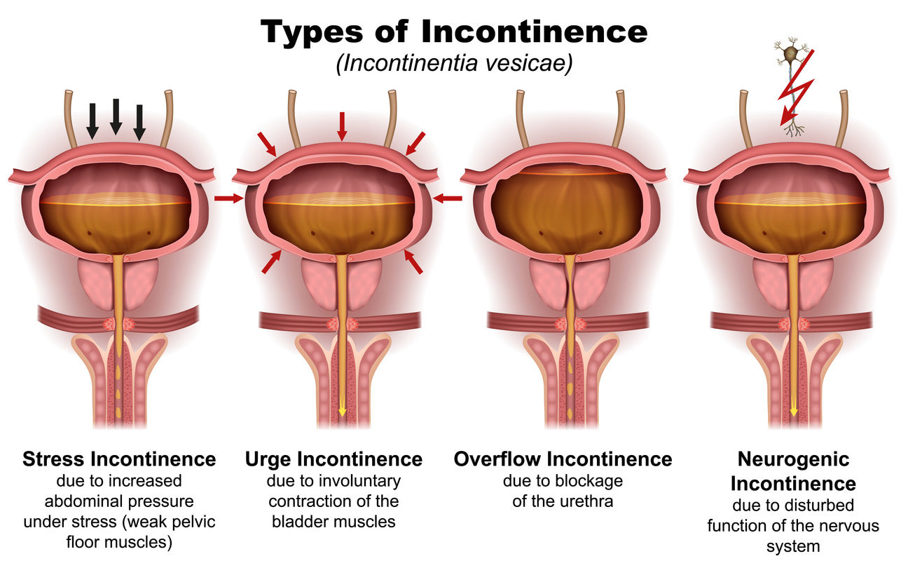 Type of Incontinence